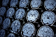 MRI